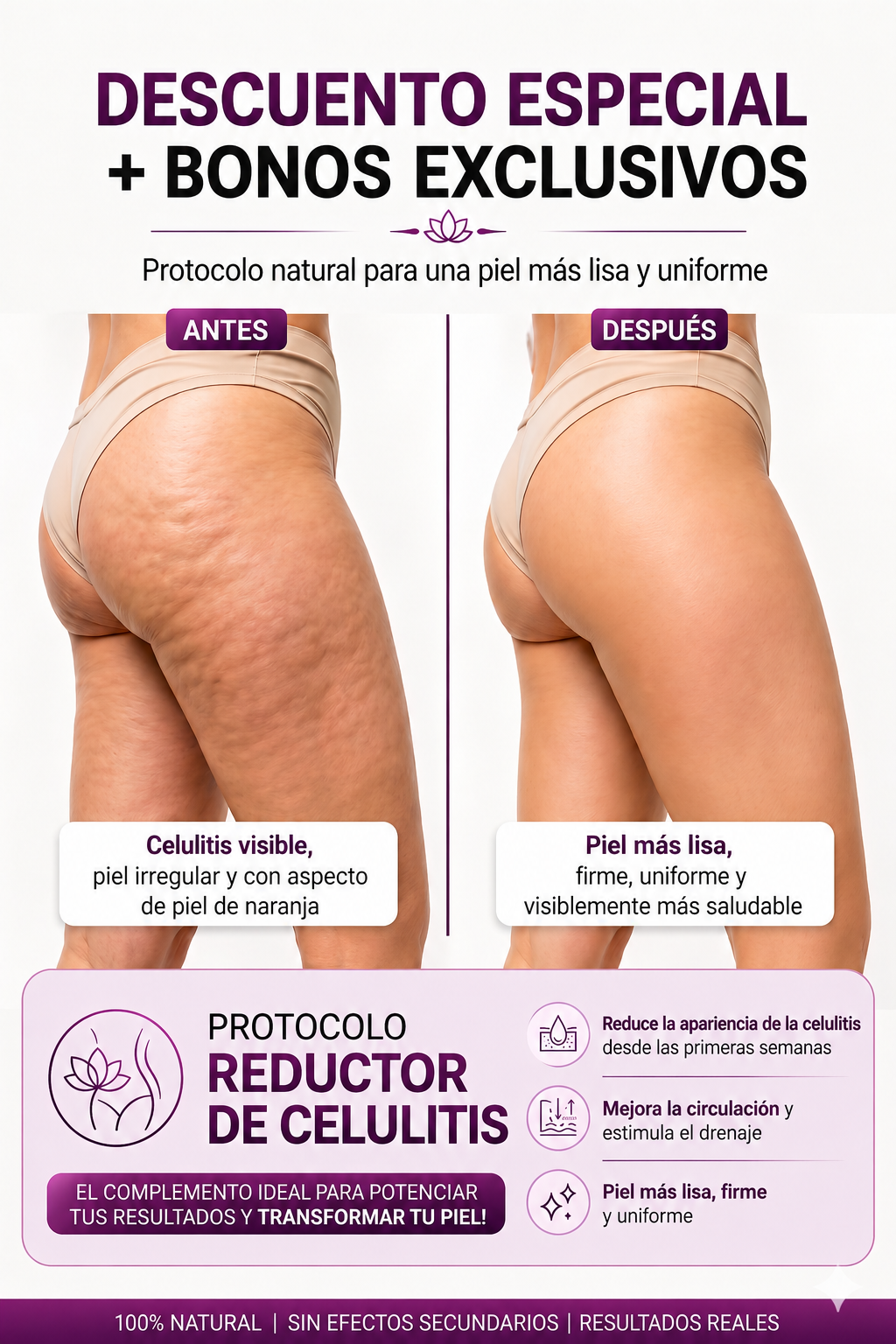 Antes y Después de la Celulitis